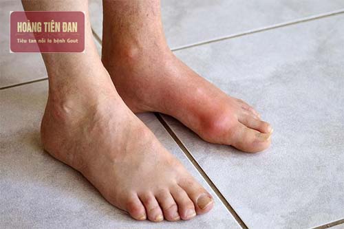  Thận suy yếu sẽ khiến người bệnh có nguy cơ cao bị gout