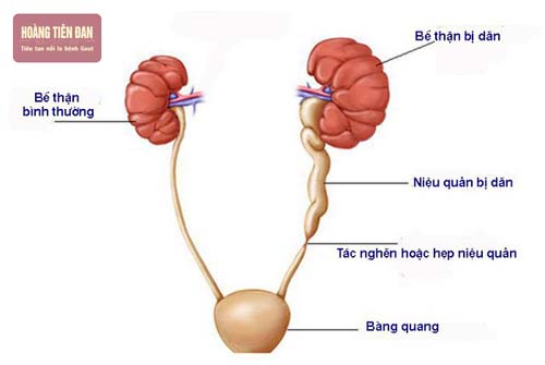    Sỏi thận gây tắc nghẽn và ứ đọng nước trong bể thận.