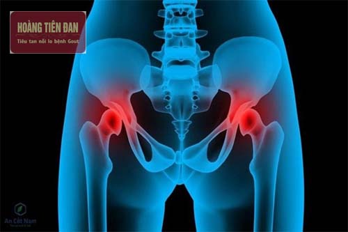 Thoái hóa khớp háng thường gặp ở người cao tuổi