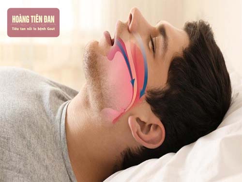 Chứng ngưng thở khi ngủ gặp nhiều hơn ở người bị béo phì