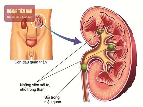 Sỏi thận kéo dài có thể gây viêm thận và suy thận.