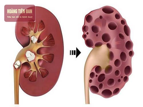 Biến chứng gout cấp có thể gây ra suy thận