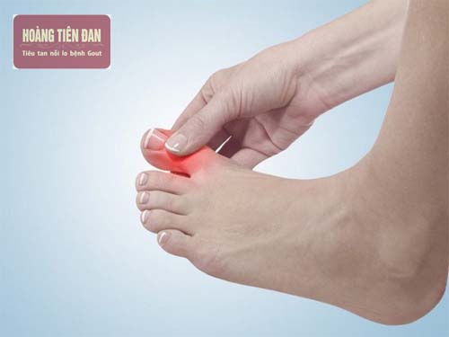 Các cơn đau do gout thường xuất hiện đầu tiên ở ngón chân cái