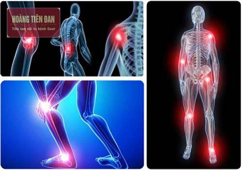 Bệnh giả gout rất dễ nhầm lẫn với bệnh gout.