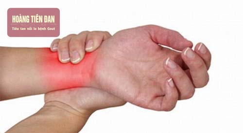 Bệnh gout giai đoạn đầu thường xảy đến với cơn đau khớp đột ngột.
