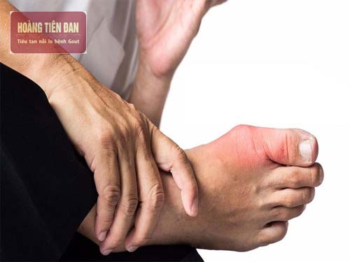  Bệnh viêm khớp thường xuất hiện chủ yếu ở phụ nữ.