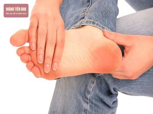 Bệnh gout thường xuất hiện ở nam giới và trong độ tuổi trung niên.