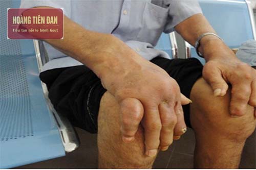 Biến chứng của bệnh gout gây tổn thương xương khớp.