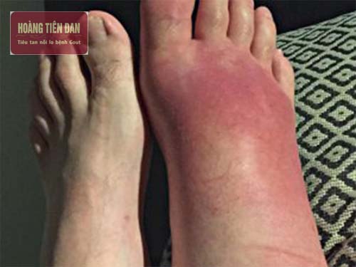 Bệnh gout hình thành do acid uric dư thừa trong máu.