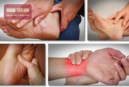 Cơn đau gout có thể xảy ra ở tất cả các khớp trong cơ thể.