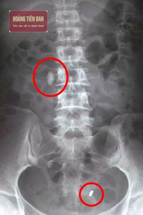 Hình ảnh sỏi thận khi chụp X quang.