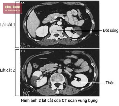  Chụp CT giúp chẩn đoán sỏi thận.