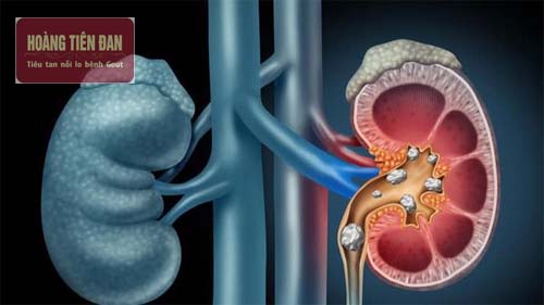 Sỏi thận thường gây đau đớn dữ dội ở lưng và mạn sườn.