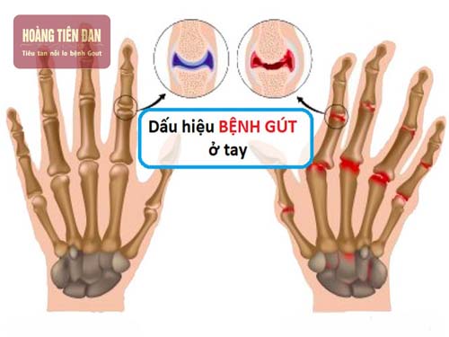  Có nhiều dấu hiệu để nhận biết bệnh gout ở tay