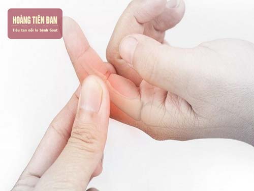  Bệnh gout cũng có thể xuất hiện triệu chứng ở tay