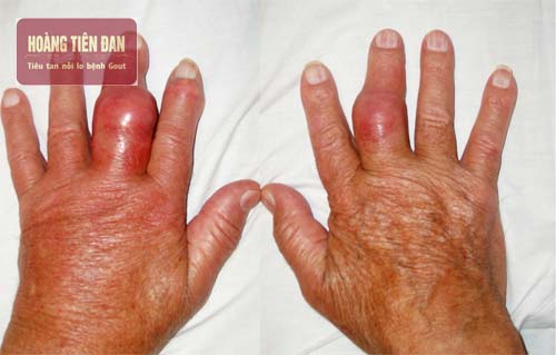  Gout ở tây gây đau nhức, khó chịu thậm chí gây biến dạng khớp