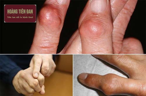  Cần phát hiện và điều trị kịp thời để ngăn ngừa biến chứng nguy hiểm