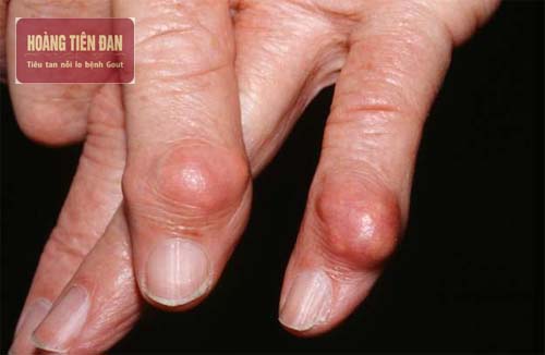  Gout ở tây là một trong những bệnh lý về xương khớp nguy hiểm