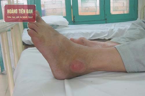  Bệnh gout cũng là một trong những nguyên nhân gây đau khớp cổ chân.