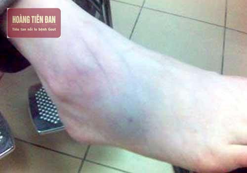   Đau khớp cổ chân do bong gân có thể uống thuốc giảm đau.