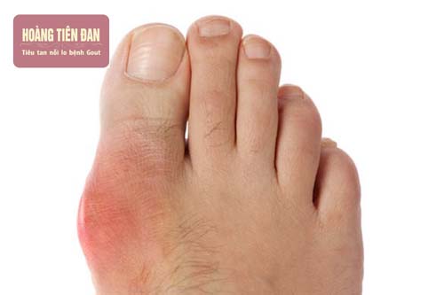 Khớp ngón chân bị sưng đau và có màu đỏ