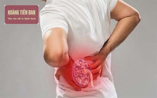  Các bệnh ở tuyến tiền liệt cũng có thể gây sỏi thận.