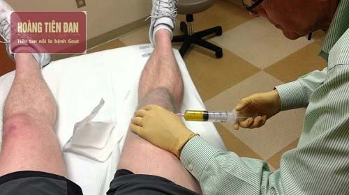  Hút dịch acid uric để xét nghiệm dịch khớp và chẩn đoán bệnh gout