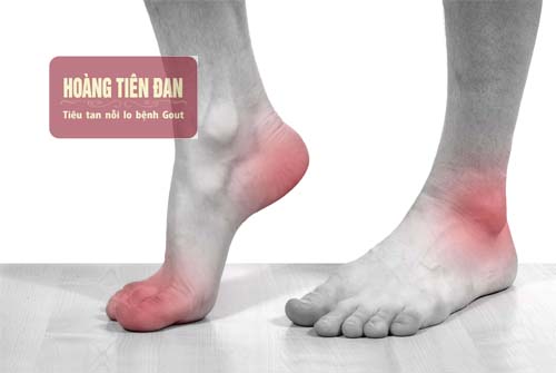  Gout ở mắt cá chân khiến người bệnh gặp khó khăn khi di chuyển.