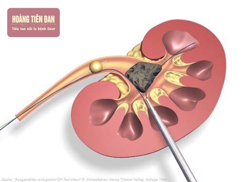 Nếu không mổ sỏi thận kịp thời có thể gây vỡ bể thận.