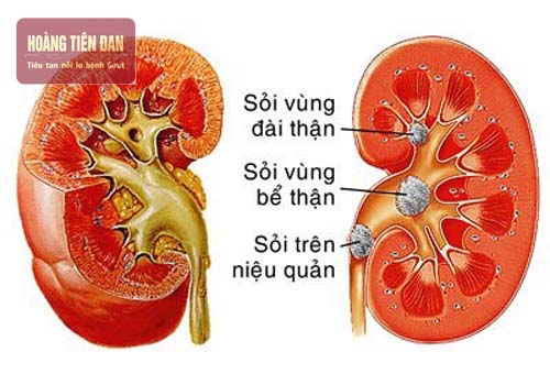 Mổ sỏi thận được chỉ định khi kích thước sỏi lớn.