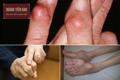  Khi bệnh nặng hơn ở khớp sẽ xuất hiện những hạt tophi