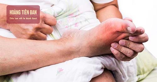 Gout cũng là nguyên nhân gây sưng đau ngón chân cái