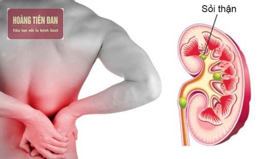 Bệnh sỏi thận thường gây đau ở vùng hông và vùng lưng.
