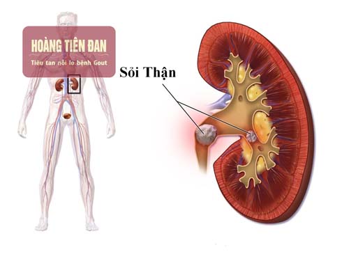 Sỏi thận hình thành do lắng đọng các chất có trong nước tiểu.