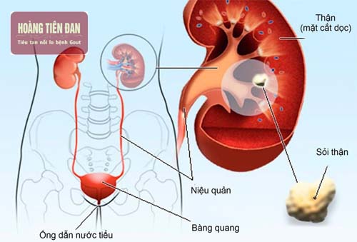   Sỏi thận kéo dài có thể gây đau đớn và nhiễm trùng đường tiểu.