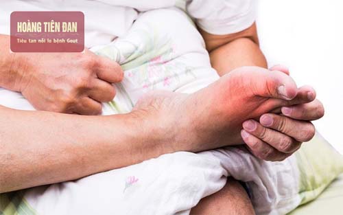  Gout thường tái phát gây đau đớn theo từng đợt.