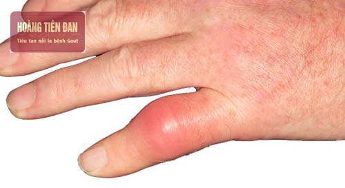 Nguyên nhân gây sưng đỏ khớp ngón tay