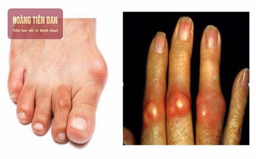   Gout gây sưng đau khớp ngón tay và chân