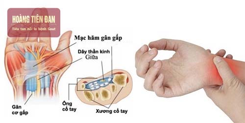 Nguyên nhân gây tràn dịch khớp cổ tay