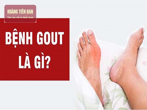 Gout là một căn bệnh phổ biến