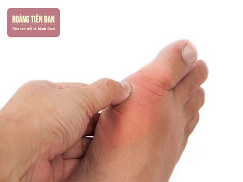 Cơn đau do gout sẽ xuất hiện đầu tiên ở khớp ngón chân