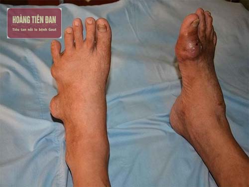   Các hạt tophi xuất hiện là triệu chứng của bệnh gout nghiêm trọng