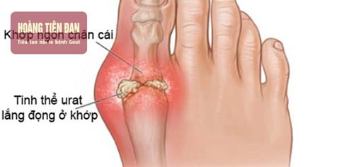 Gout thường hay tái phát vào mùa đông.