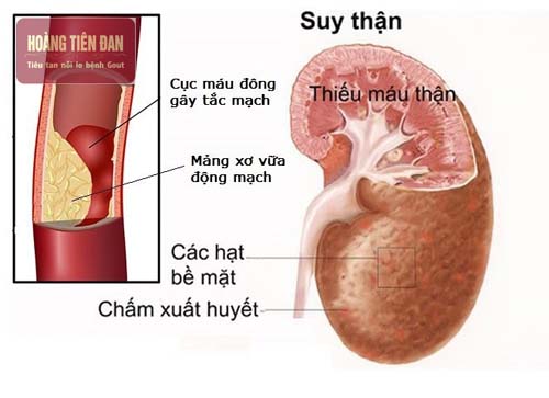 Biến chứng nguy hiểm của suy thận.