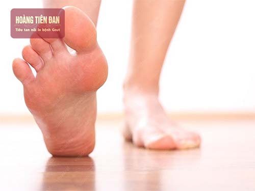 Đau gót chân là một trong những biểu hiện khi mắc bệnh gout