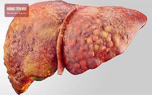 Người nghiện rượu có nguy cơ mắc xơ gan cao