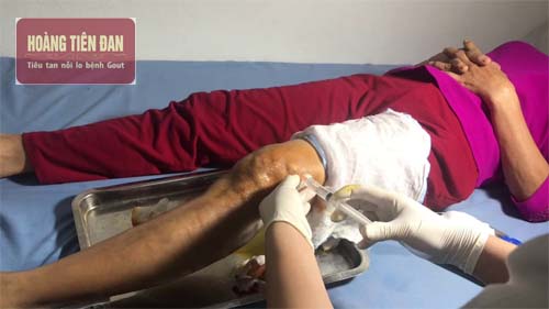  Thực hiện hút dịch khớp gối theo đúng quy trình nghiêm ngặt.