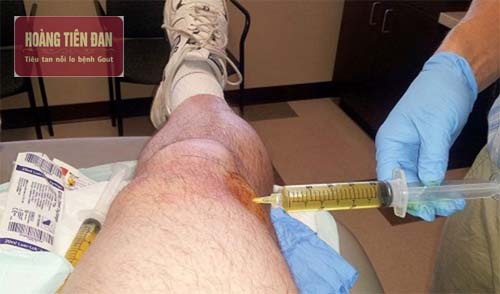  Hút dịch tại khớp gối.