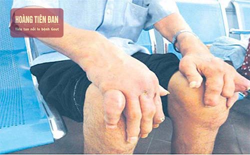 Gout gây biến dạng các khớp