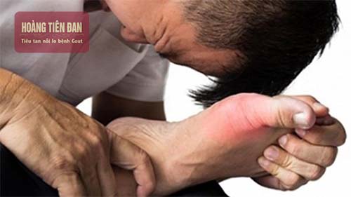 Gout gây đau nhức ở các khớp